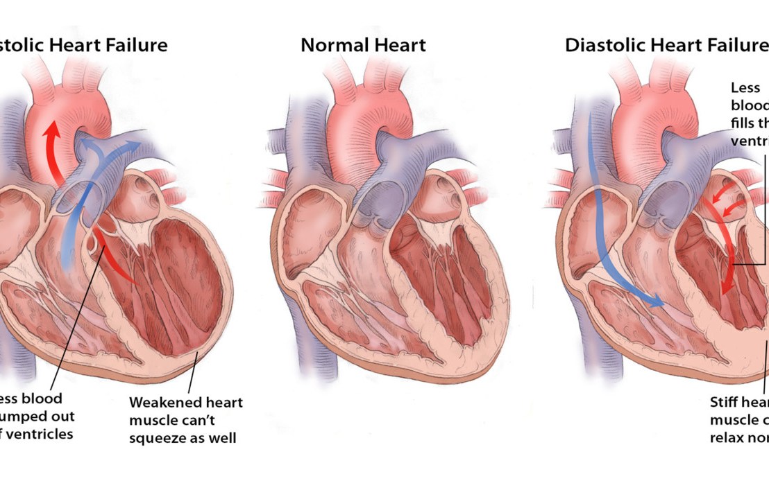 Diastolic heart failure