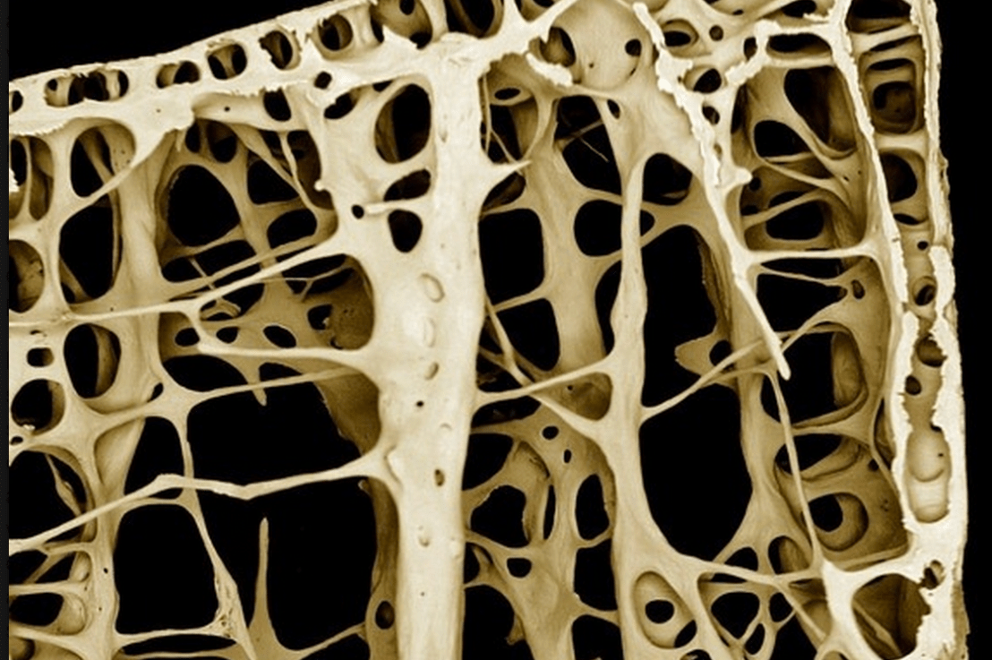 Osteoporosis